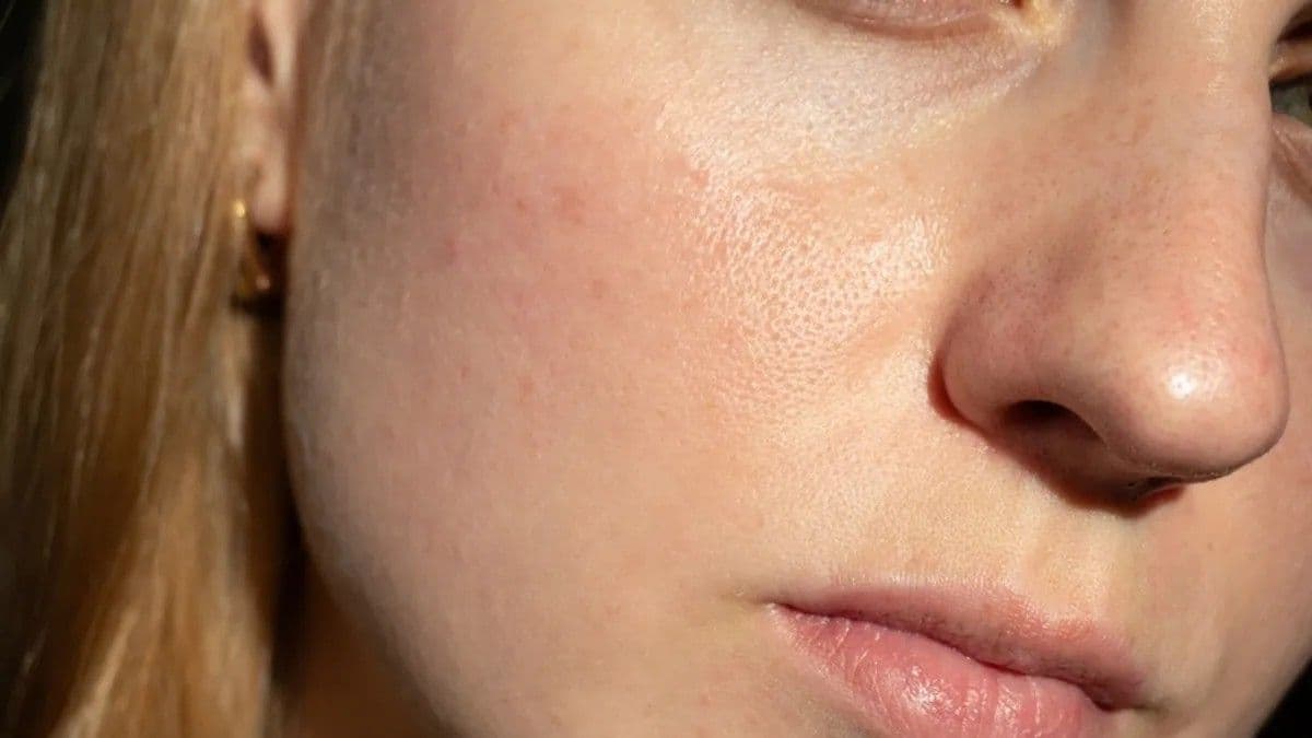 6 bőrtünet, ami elárulja: vitaminhiány fenyeget!